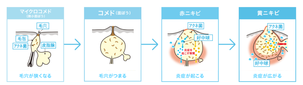 当院でのにきび治療の方針と工夫 越谷市南越谷駅の整形外科 皮膚科 美容皮膚科 内科 南越谷病院